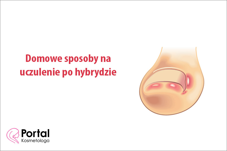 Domowe sposoby na uczulenie po hybrydzie