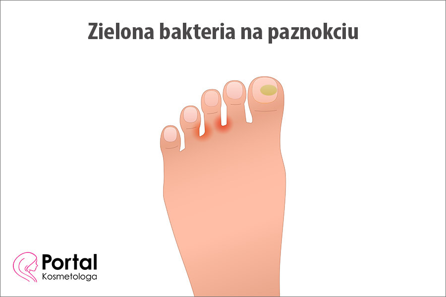 Zielona bakteria na paznokciu