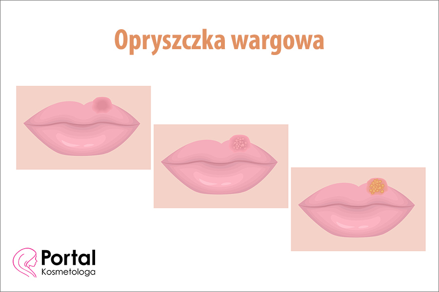 Opryszczka wargowa