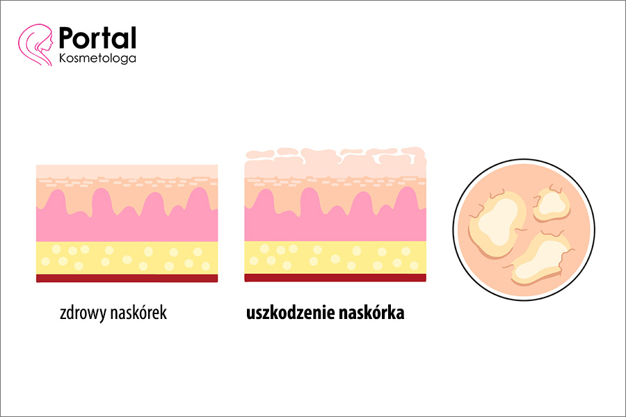 Uszkodzenie naskórka