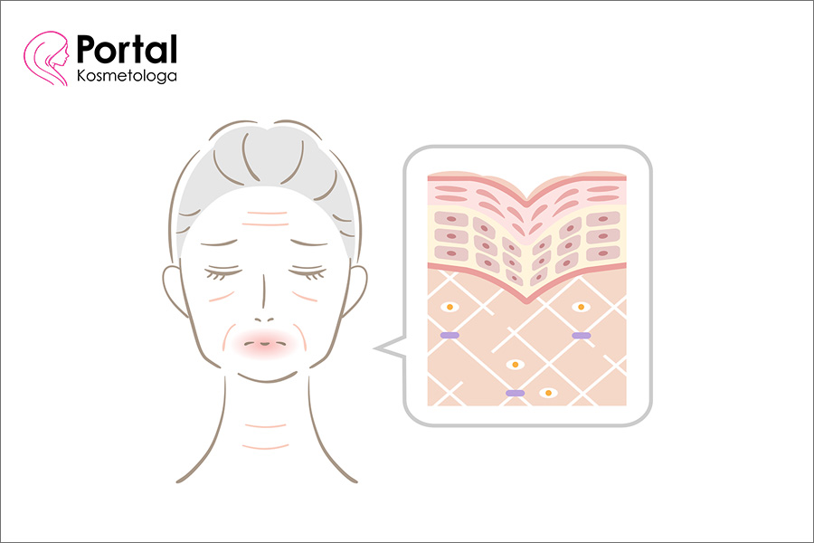 Dermatoporoza