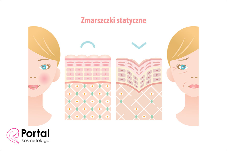 Zmarszczki statyczne