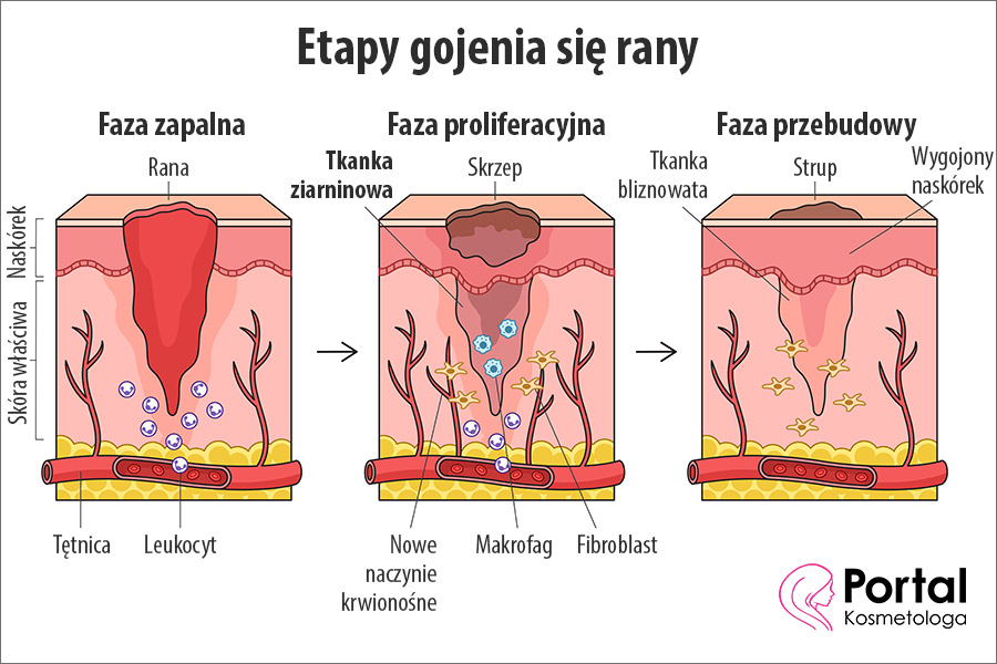 Tkanka ziarninowa