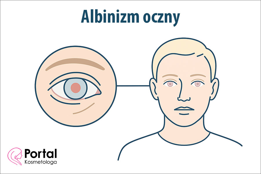 Albinizm oczny