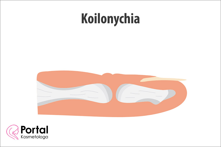 Koilonychia