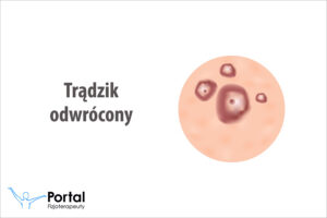 Trądzik odwrócony