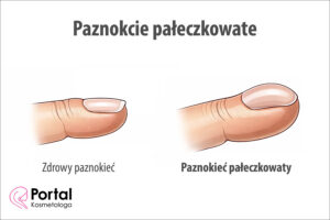 Paznokcie pałeczkowate