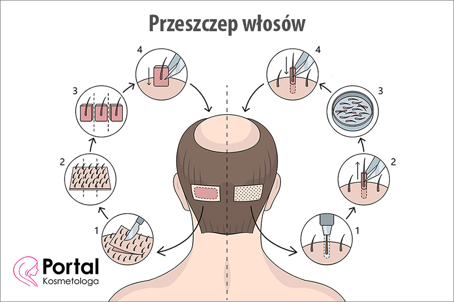 Przeszczep włosów