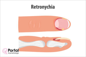 Retronychia