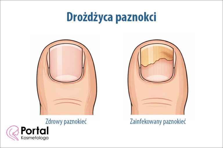 Drożdżyca paznokci