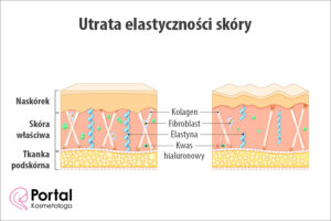 Utrata elastyczności skóry