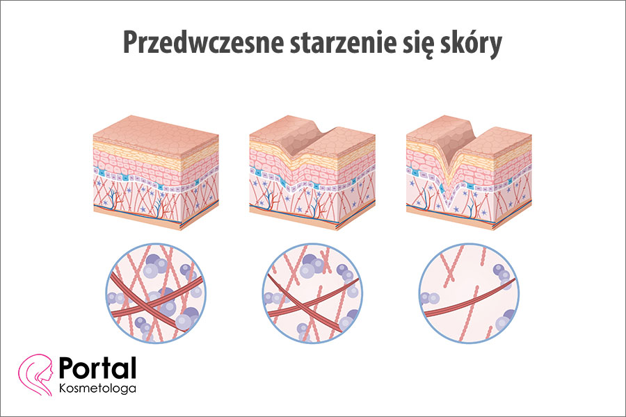 Przedwczesne starzenie się skóry