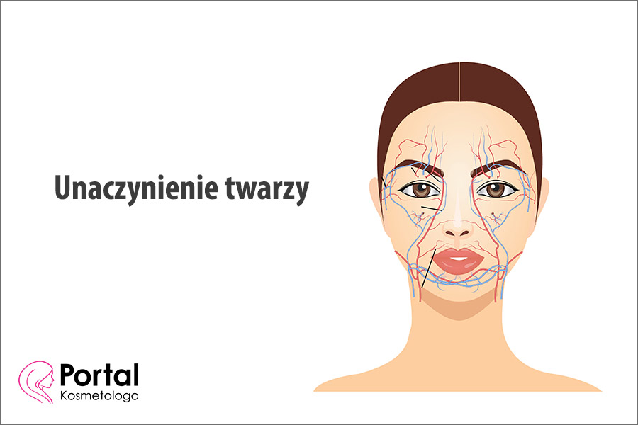 Unaczynienie twarzy
