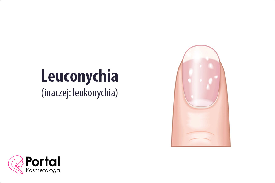 Leuconychia (leukonychia)