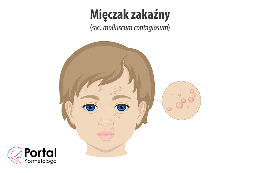 Mięczak zakaźny