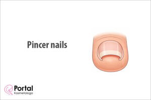 Pincer nails