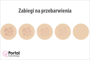 Zabiegi na przebarwienia