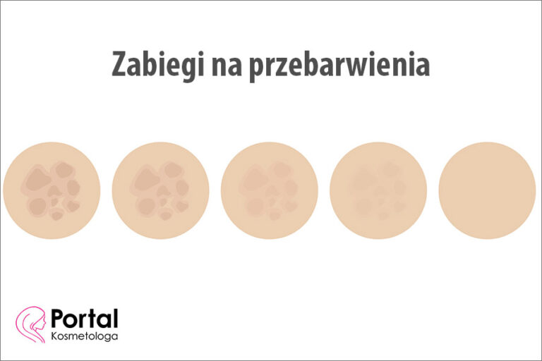 Zabiegi na przebarwienia
