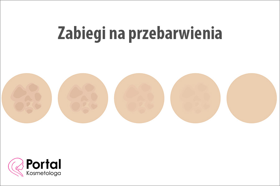 Zabiegi na przebarwienia