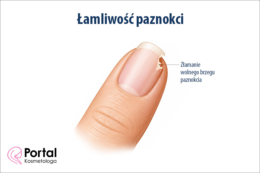 Łamliwość paznokci
