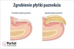 Zgrubienie płytki paznokcia