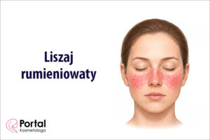 Liszaj rumieniowaty