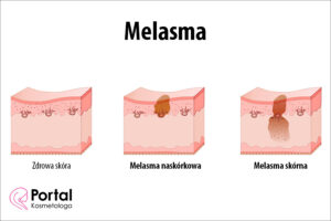 Melasma