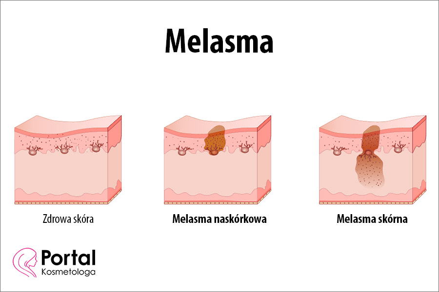 Melasma