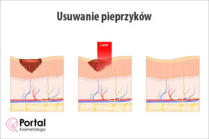 Usuwanie pieprzyków