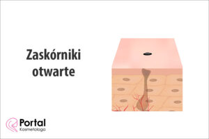 Zaskórniki otwarte
