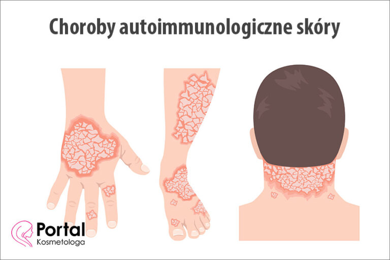 Choroby autoimmunologiczne skóry