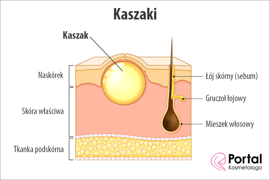 Kaszaki