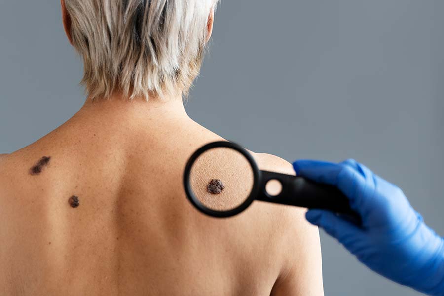 Kiedy warto wykonać dermatoskopię?