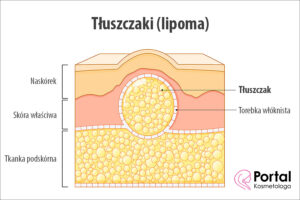 Tłuszczaki