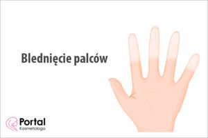 Blednięcie palców