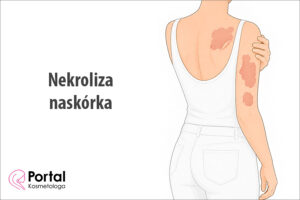 Nekroliza naskórka
