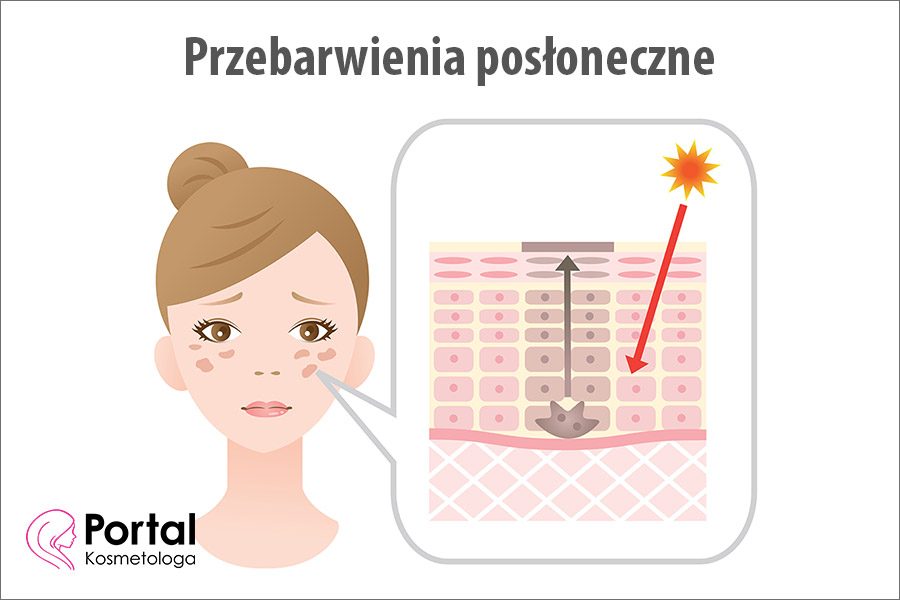 Przebarwienia posłoneczne