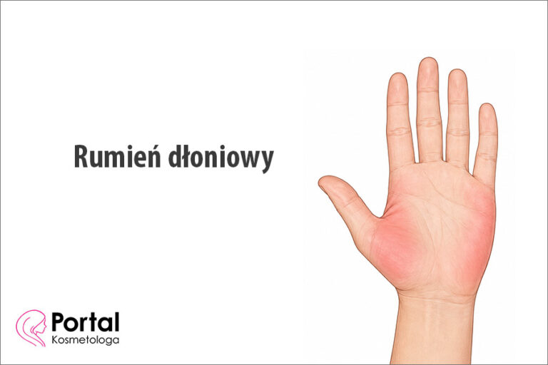 Rumień dłoniowy