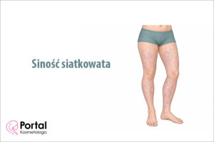 Siność siatkowata