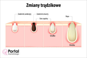 Zmiany trądzikowe