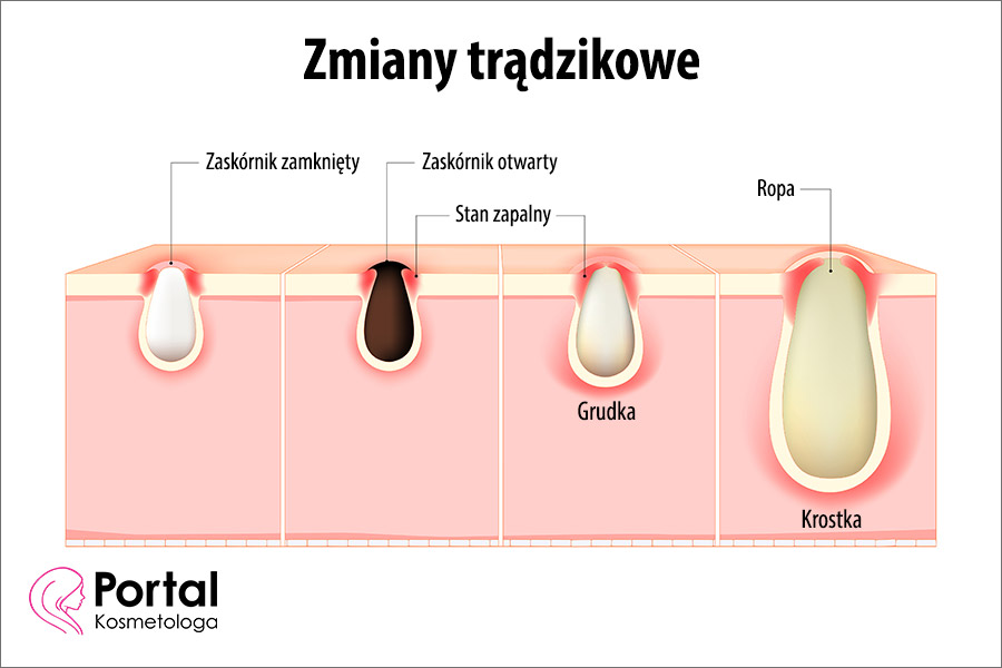 Zmiany trądzikowe