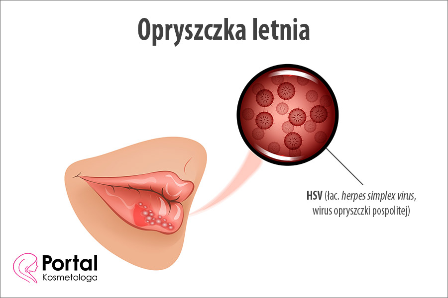 Opryszczka letnia