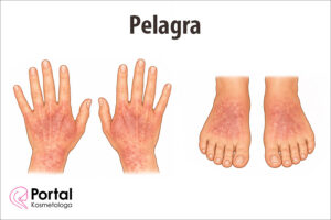 Pelagra