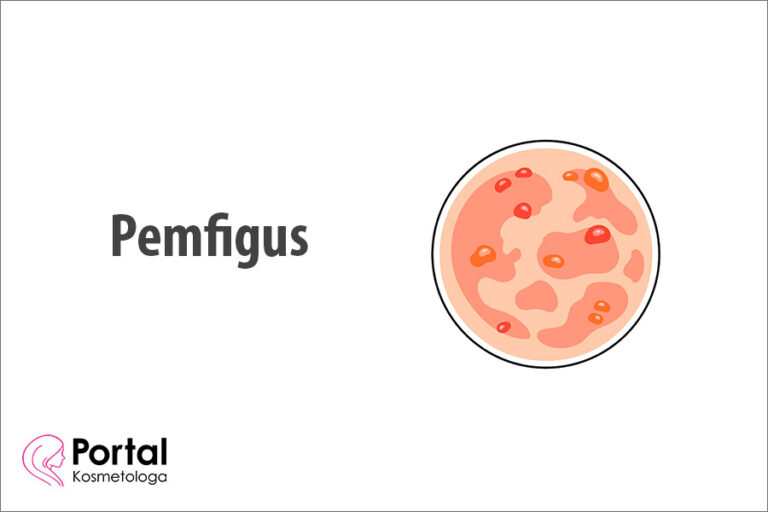 Pemfigus