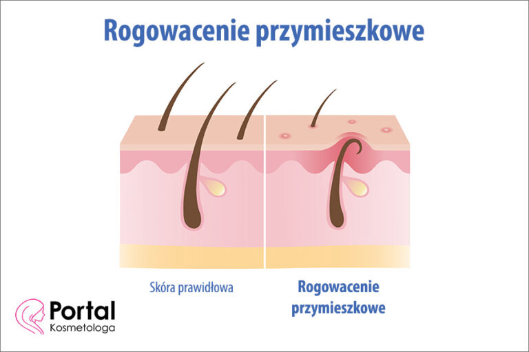 Rogowacenie przymieszkowe